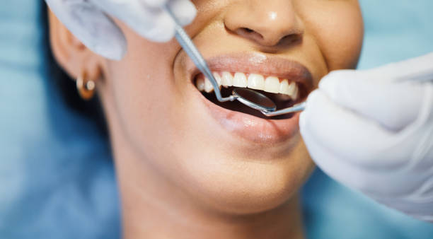 Best Knocked-Out Tooth (Avulsed Tooth) Treatment in Huntsville, TX